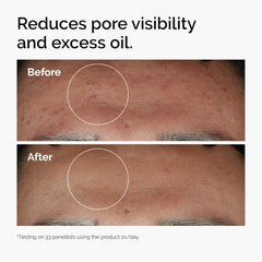 The Ordinary Niacinamide 10% + Zinc 1% Serum – Brightening and Smoothing Skincare for Blemish-Prone Skin, 30ml