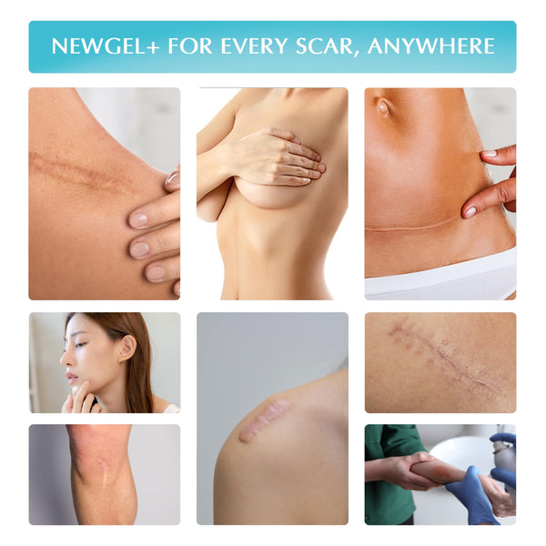 MyNewGel Advanced High-Potency Silicone Scar Gel with Vitamin E for Old, New Scars, Surgery, Keloids, Burns, and Facial Blemish Scars, NewGel Plus by MyNewGel (15 Grams) - 0.50 oz
