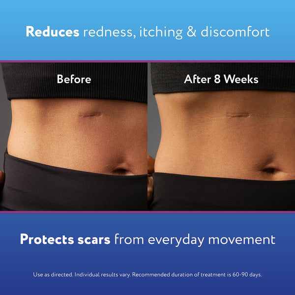 ScarAway Scar Away Scar Repair Gel With Patented Kelo-Cote Technology, 20 Grams